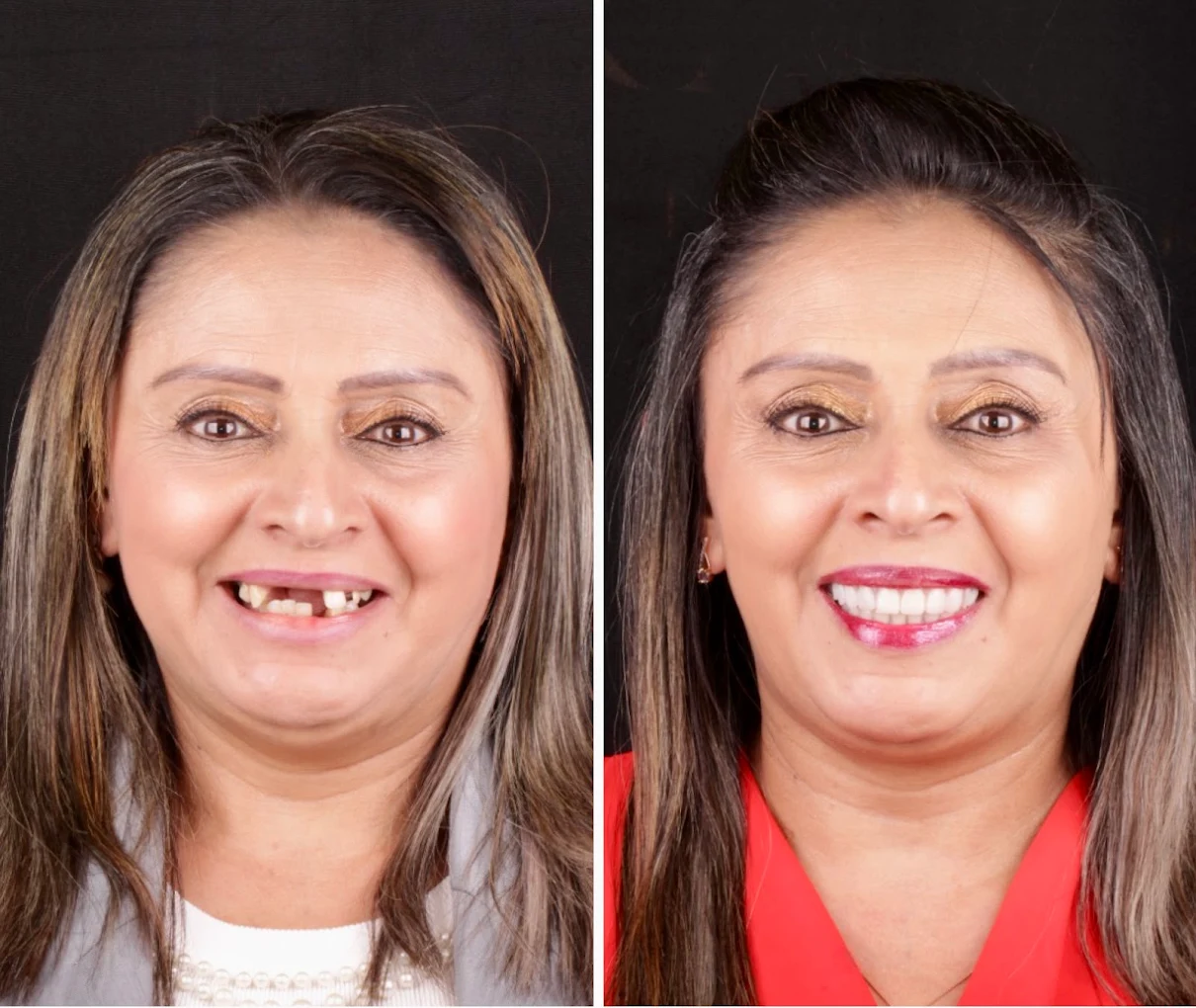 Implante DEntário Zona Leste Antes e DEpois