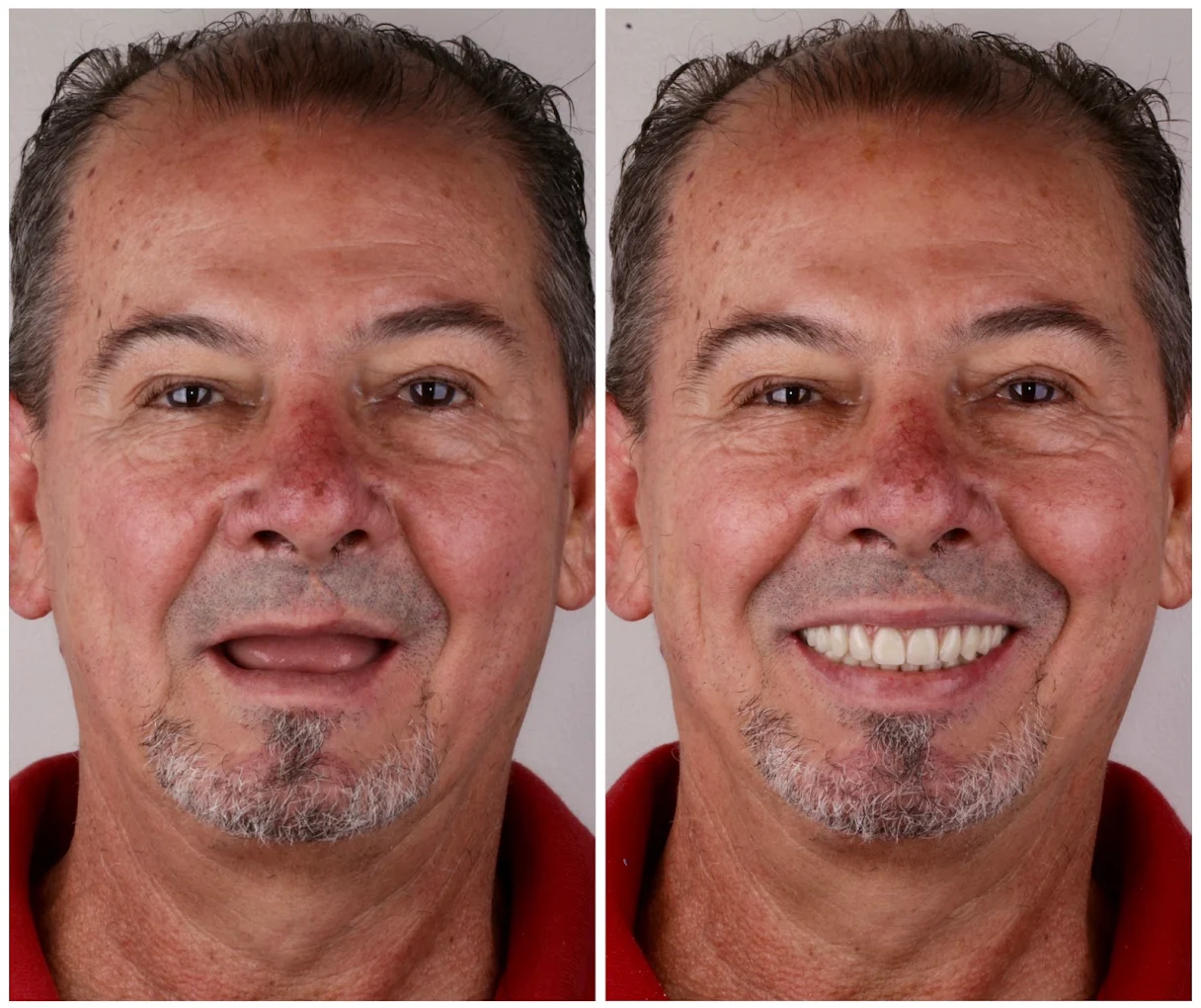 Implantes Dentários Antes e DEpois Zona Leste SP