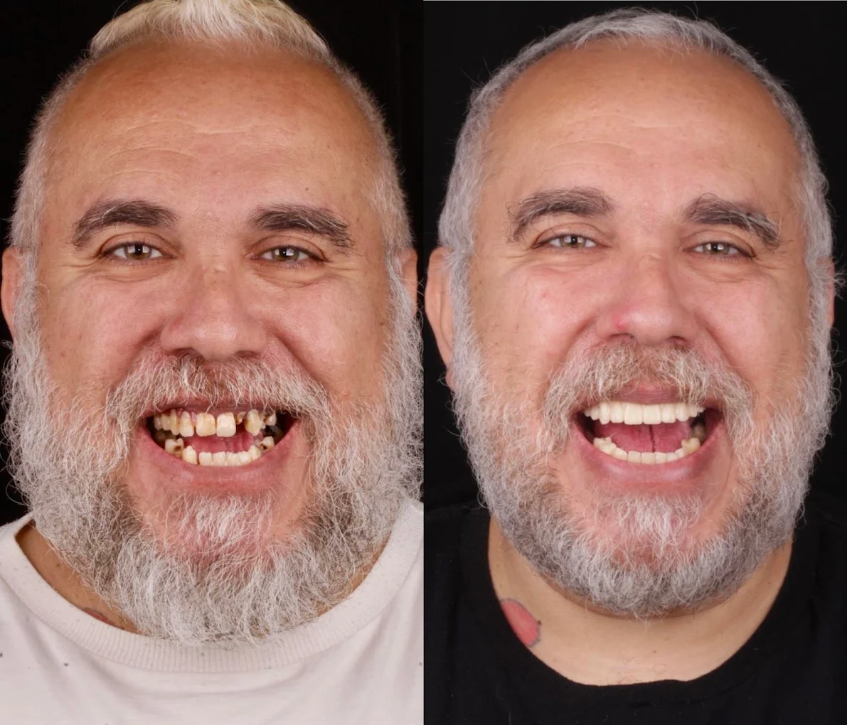 Prótese Protocolo Antes e Depois Vila Carrão