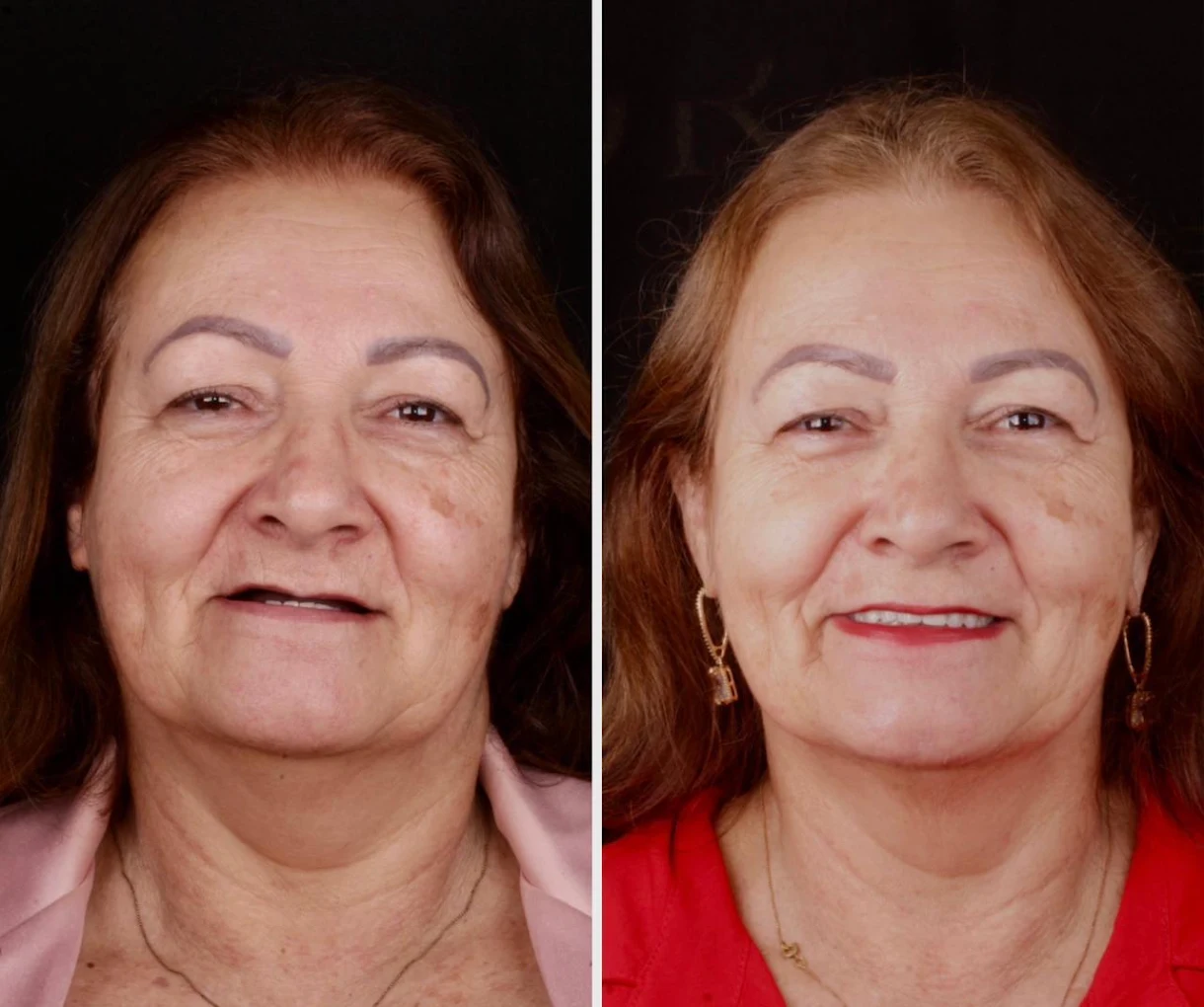 Prótese Protocolo Vila Carrão Zona Leste Antes e Depois